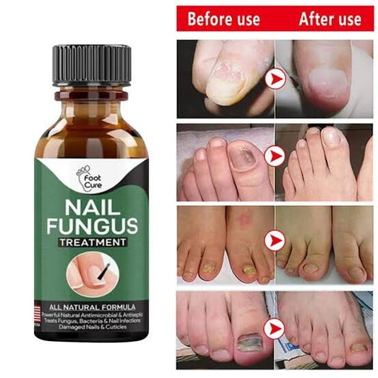 FOOT CURE Extra Strong Organic & USA Made Finger & Toenail Fungus Treatment