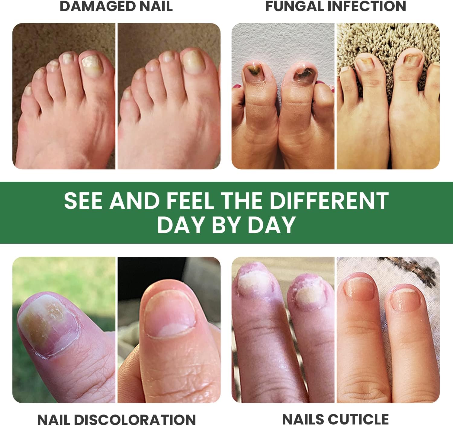 FOOT CURE Extra Strong Organic & USA Made Finger & Toenail Fungus Treatment